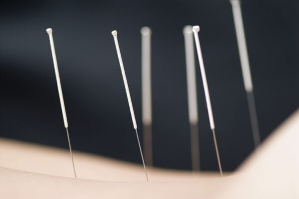 What Is Dry Needling?
