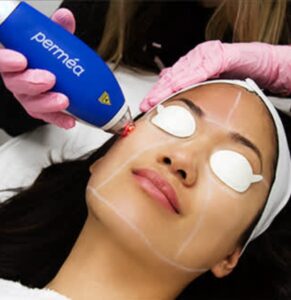Woman receiving a laser skin treatment at a clinic.