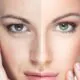Split image showing a woman's face with skin imperfections on one side and flawless skin on the other.
